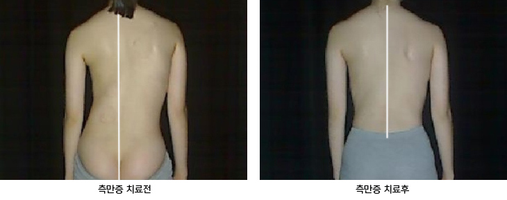 체형교정 치료 전후 비교